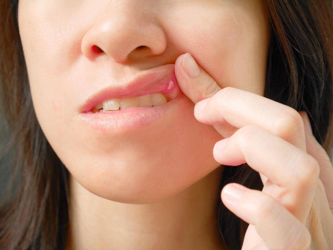 حبوب الشفايف داخل الفم.. أسبابها وطرق علاجها