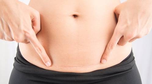 فوائد كريم أفوميب.. للوجه والحروق وإخفاء خياطة الولادة 12 استخدام كريم افوميب لإخفاء خياطة الولادة