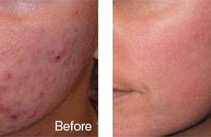 before after acne 635412be c133 41df 80ff 045c73c3a210 grande