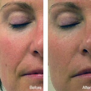 before after face wrinkle bd8a1909 db59 4367 9b58 c99947e46526 grande