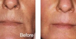 before after mouth wrinkle 77f3e4ce 0eea 4850 b6db 81ba0eb54c0d grande