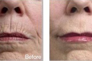 before after wrinkle ff2ad016 cf52 4771 80bb a09c775c93d2 grande