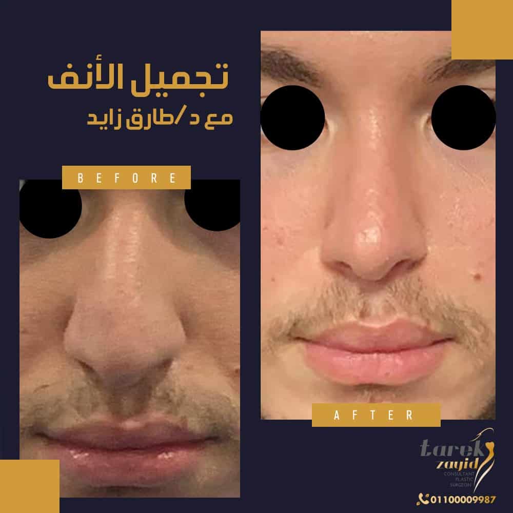  تصغير الانف لدكتور طارق زايد